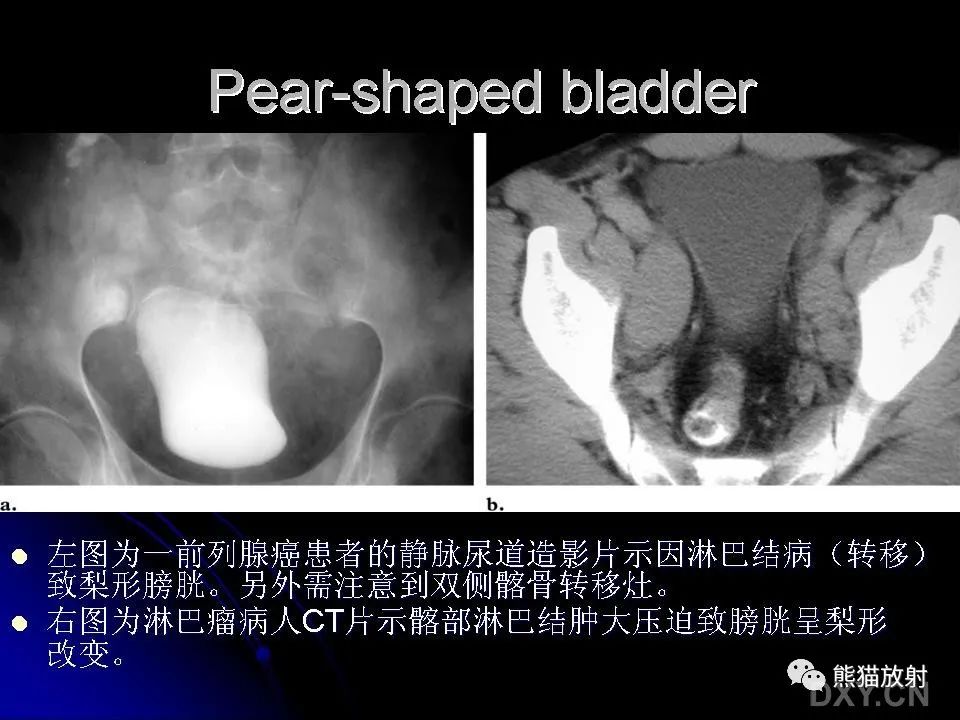 影像PPT - 【PPT】和食物有关的影像学征象-4