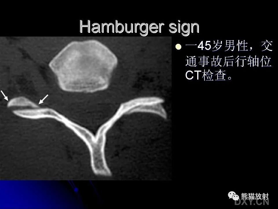 影像PPT - 【PPT】和食物有关的影像学征象-9