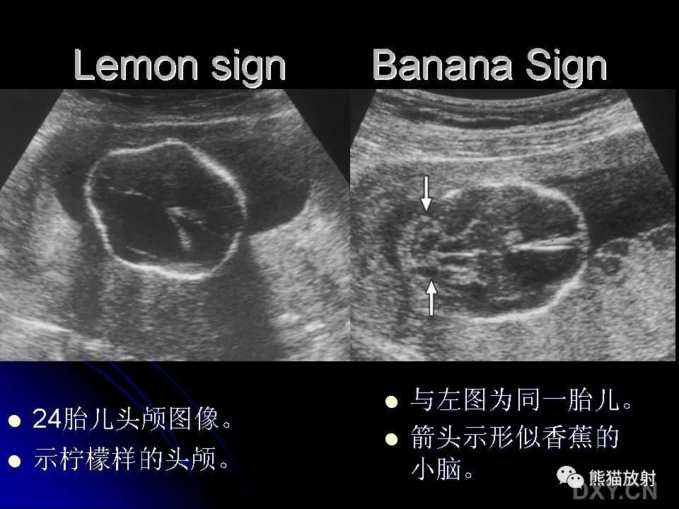 影像PPT - 【PPT】和食物有关的影像学征象-6