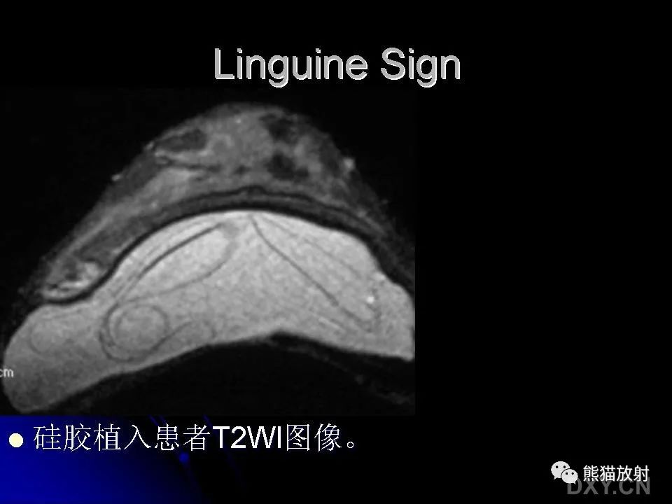 影像PPT - 【PPT】和食物有关的影像学征象-13