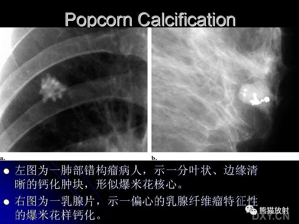 影像PPT - 【PPT】和食物有关的影像学征象-17