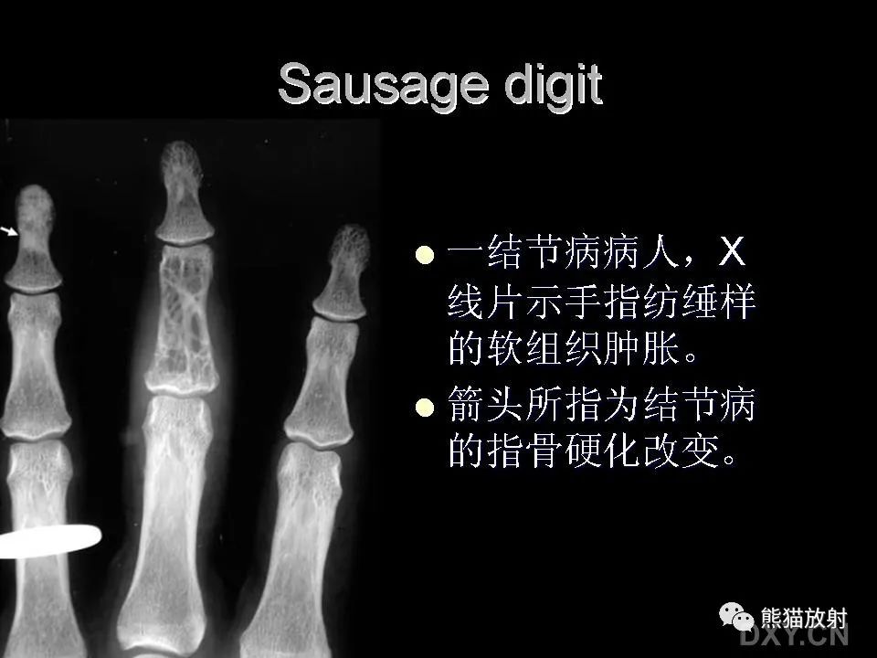 影像PPT - 【PPT】和食物有关的影像学征象-11
