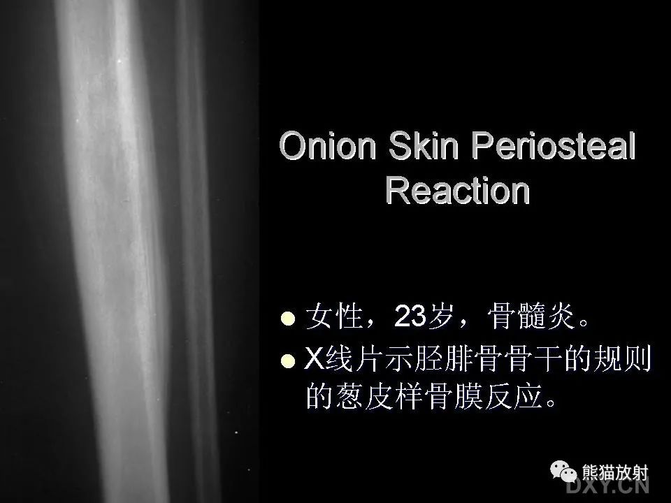 影像PPT - 【PPT】和食物有关的影像学征象-21