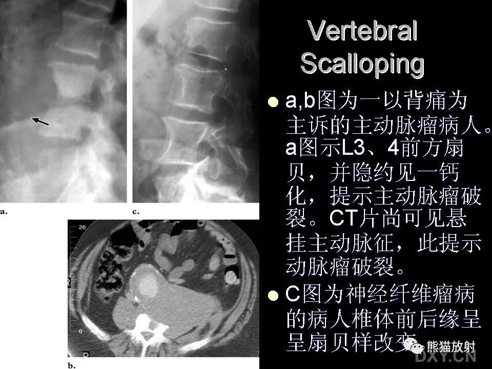 影像PPT - 【PPT】和食物有关的影像学征象-23