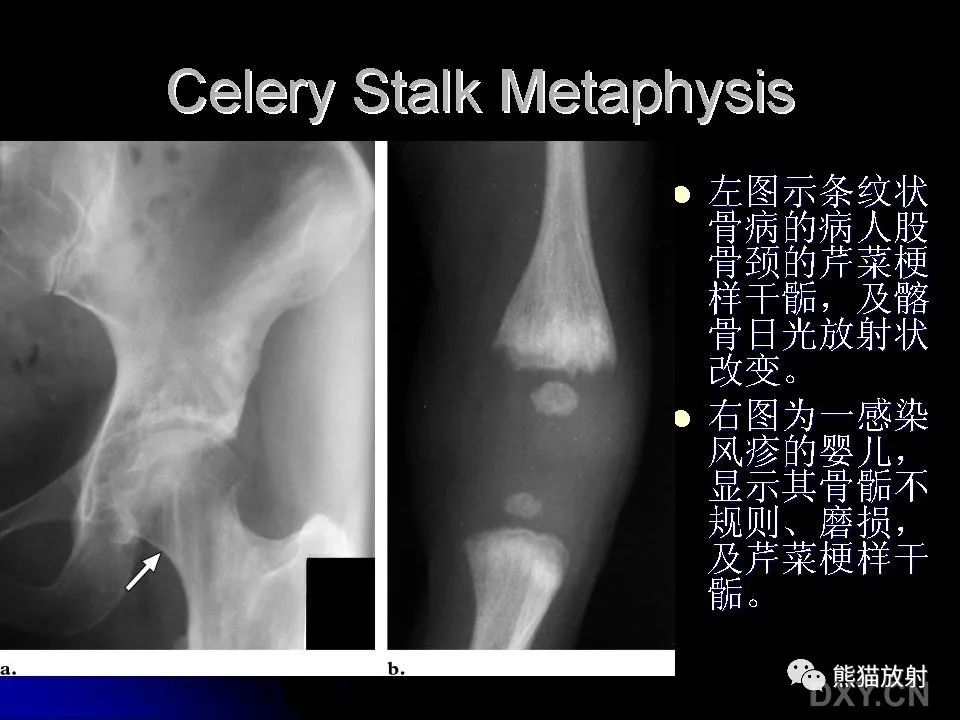 影像PPT - 【PPT】和食物有关的影像学征象-19