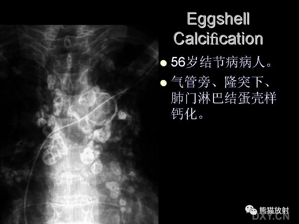 影像PPT - 【PPT】和食物有关的影像学征象-25