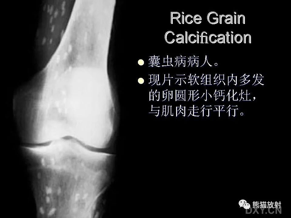影像PPT - 【PPT】和食物有关的影像学征象-27