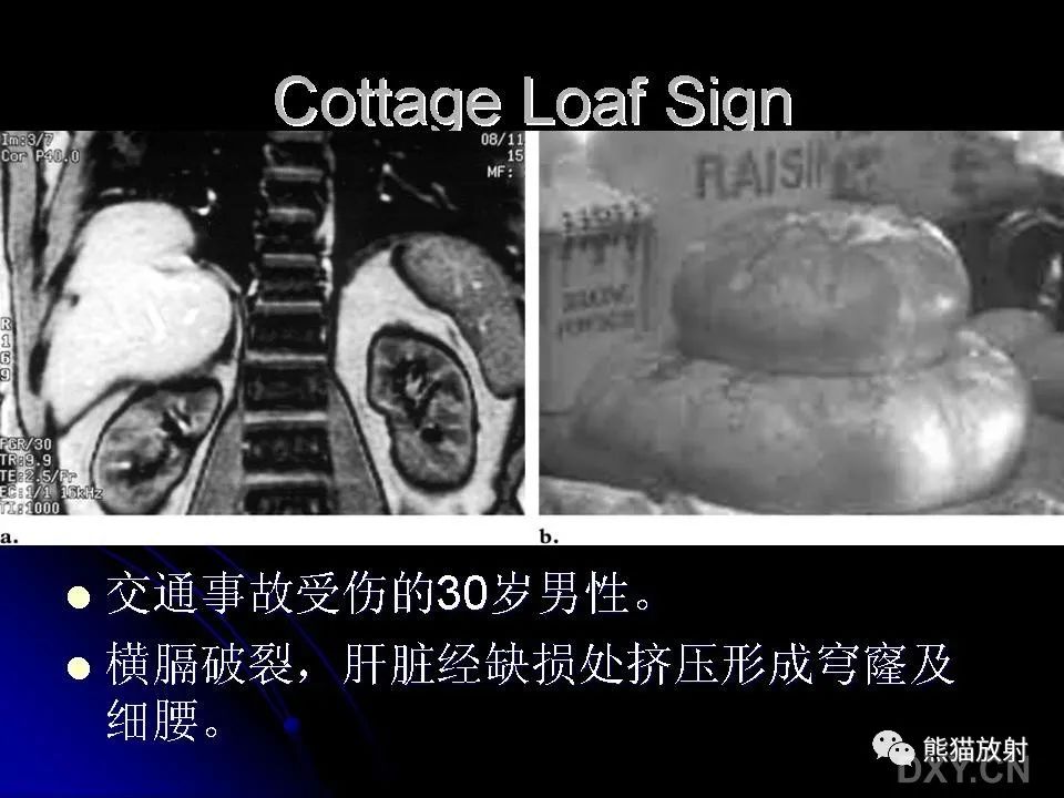 影像PPT - 【PPT】和食物有关的影像学征象-29
