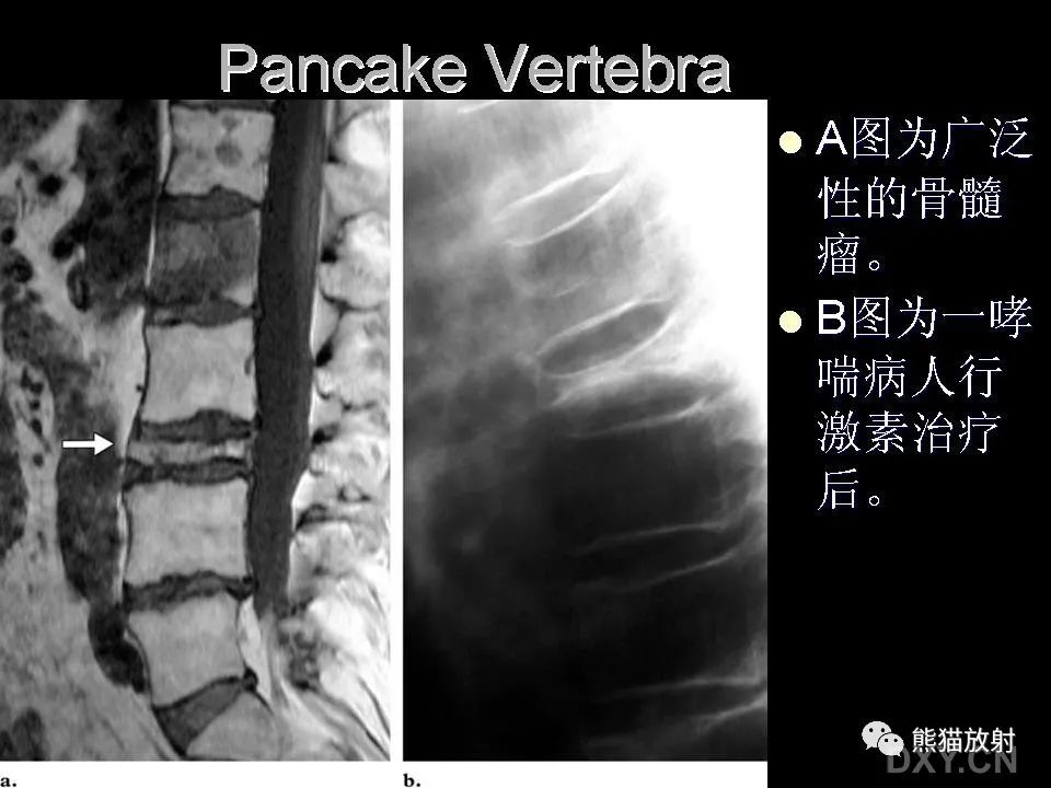影像PPT - 【PPT】和食物有关的影像学征象-37