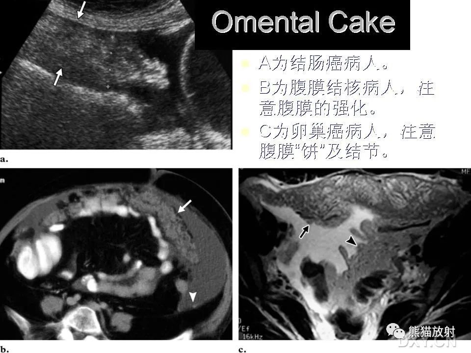 影像PPT - 【PPT】和食物有关的影像学征象-35