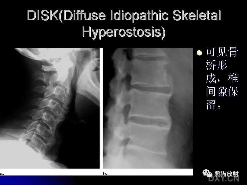 影像PPT - 【PPT】和食物有关的影像学征象-43