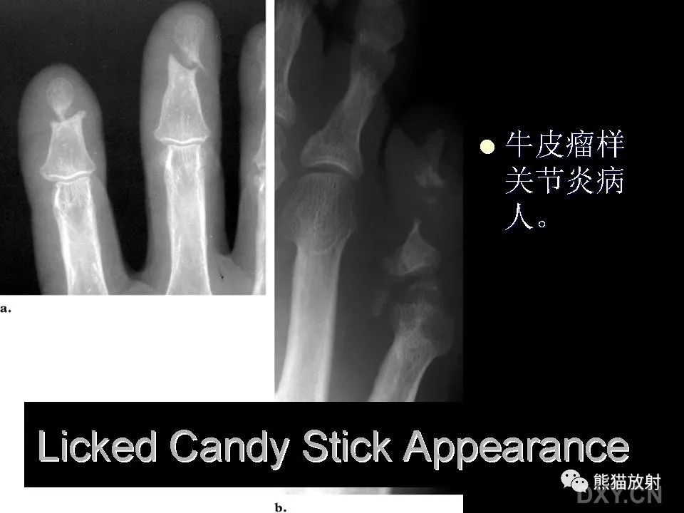 影像PPT - 【PPT】和食物有关的影像学征象-39