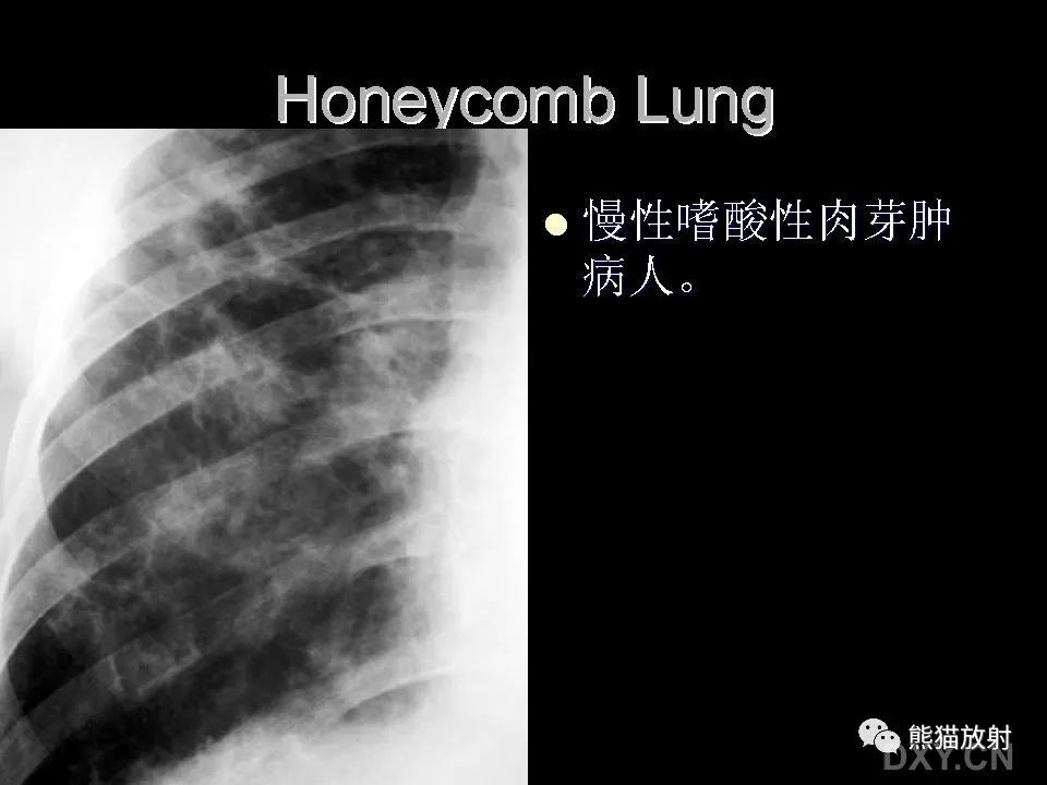 影像PPT - 【PPT】和食物有关的影像学征象-41