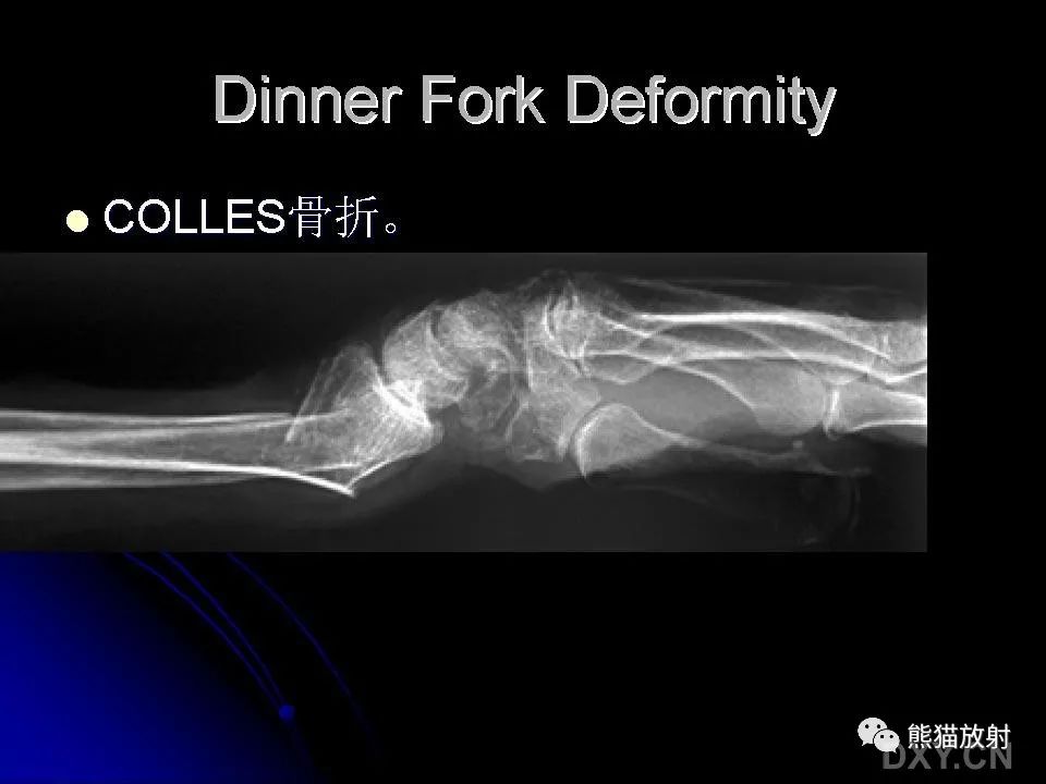 影像PPT - 【PPT】和食物有关的影像学征象-47