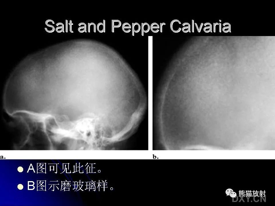 影像PPT - 【PPT】和食物有关的影像学征象-49