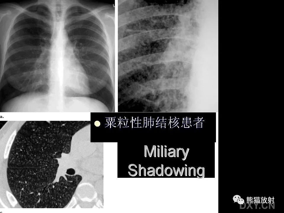 影像PPT - 【PPT】和食物有关的影像学征象-31