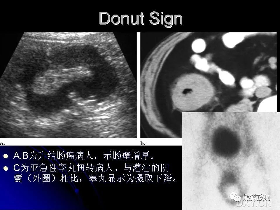 影像PPT - 【PPT】和食物有关的影像学征象-33
