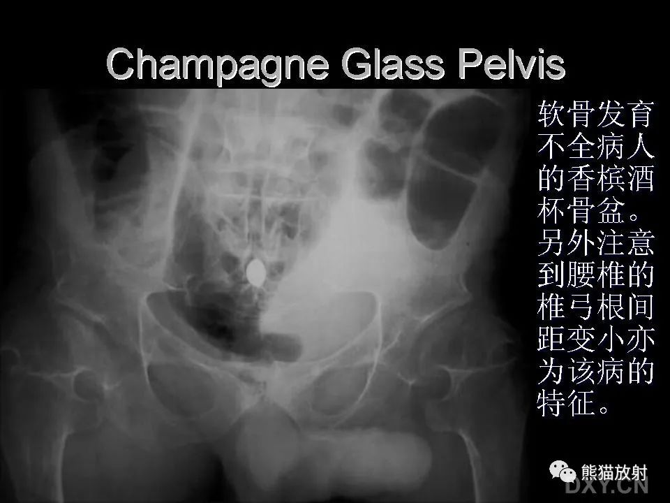 影像PPT - 【PPT】和食物有关的影像学征象-45