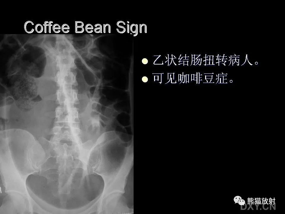 影像PPT - 【PPT】和食物有关的影像学征象-51