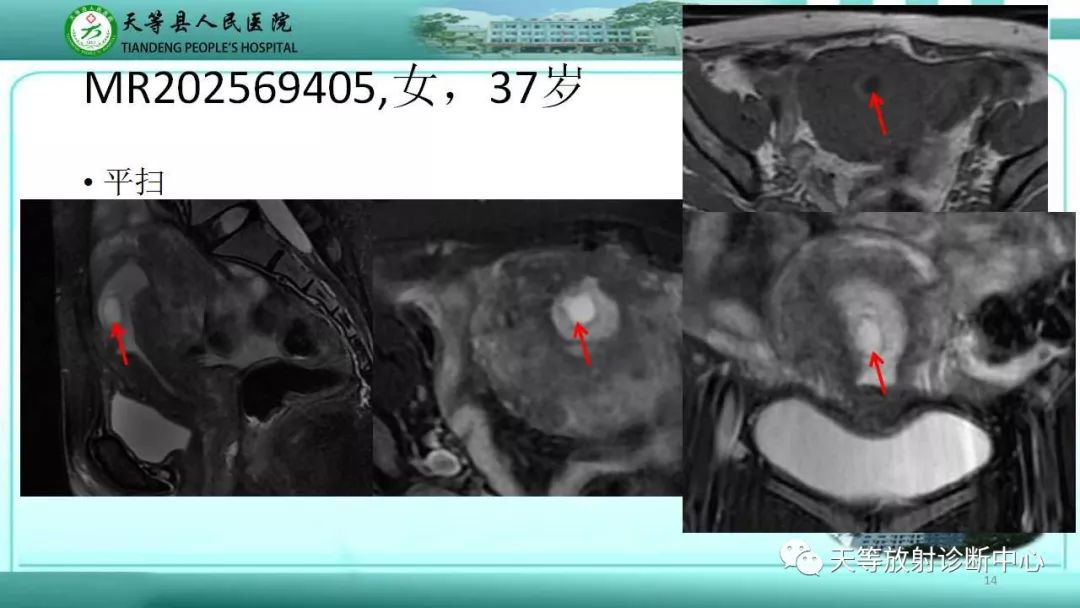 影像PPT - 子宫瘢痕妊娠(CSP)-1 影像PPT - 子宫瘢痕妊娠(CSP)-1
