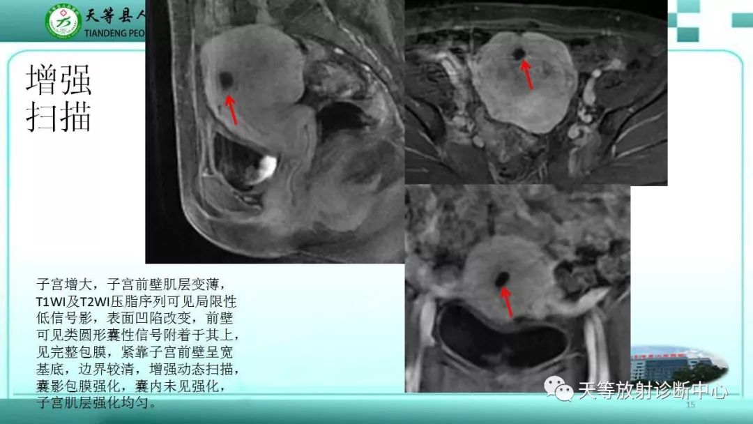 影像PPT - 子宫瘢痕妊娠(CSP)-2 影像PPT - 子宫瘢痕妊娠(CSP)-2
