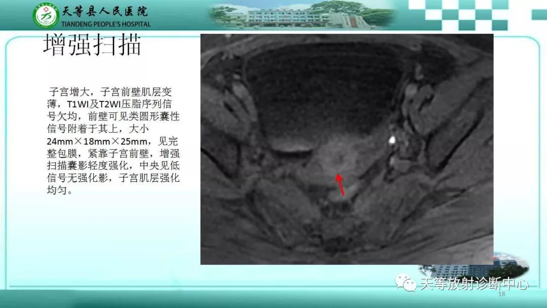 影像PPT - 子宫瘢痕妊娠(CSP)-4 影像PPT - 子宫瘢痕妊娠(CSP)-4
