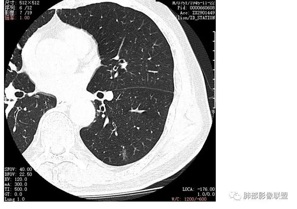 影像PPT - 【病例】月牙铲,磨玻璃,核桃征,再现重温不同心得-2 影像PPT - 【病例】月牙铲,磨玻璃,核桃征,再现重温不同心得-2