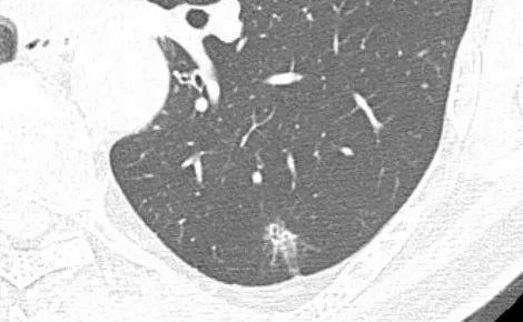 影像PPT - 【病例】月牙铲,磨玻璃,核桃征,再现重温不同心得-23 影像PPT - 【病例】月牙铲,磨玻璃,核桃征,再现重温不同心得-23