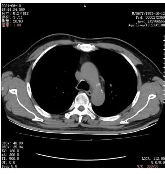 影像PPT - 【病例】月牙铲,磨玻璃,核桃征,再现重温不同心得-53 影像PPT - 【病例】月牙铲,磨玻璃,核桃征,再现重温不同心得-53