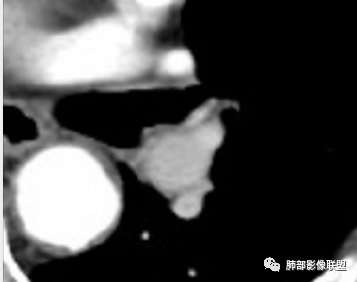 影像PPT - 【病例】月牙铲,磨玻璃,核桃征,再现重温不同心得-78 影像PPT - 【病例】月牙铲,磨玻璃,核桃征,再现重温不同心得-78