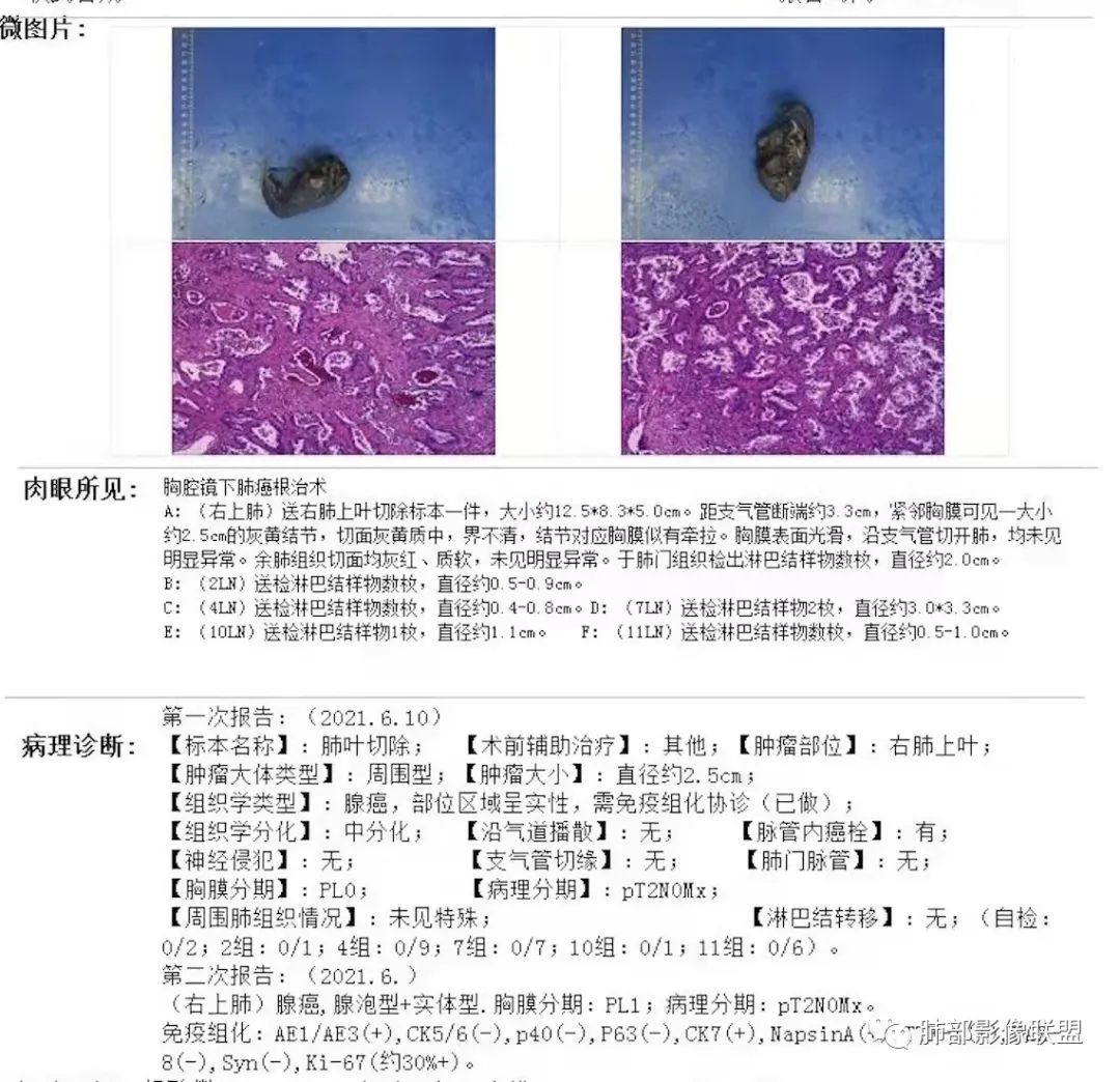 影像PPT - 【病例】月牙铲,磨玻璃,核桃征,再现重温不同心得-90 影像PPT - 【病例】月牙铲,磨玻璃,核桃征,再现重温不同心得-90