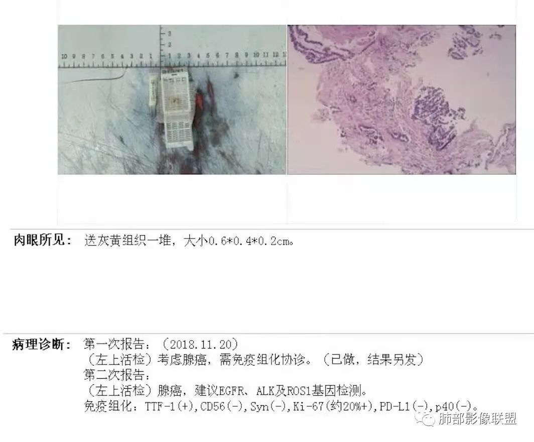 影像PPT - 【病例】月牙铲,磨玻璃,核桃征,再现重温不同心得-113 影像PPT - 【病例】月牙铲,磨玻璃,核桃征,再现重温不同心得-113