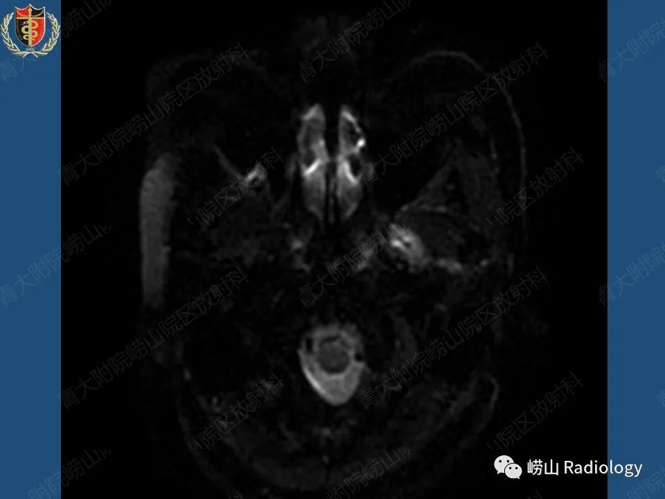 影像PPT - 【病例】三叉神经神经鞘瘤1例CT及MR影像-14