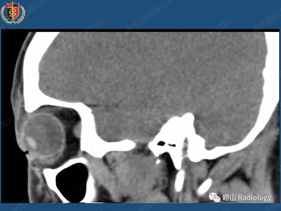 影像PPT - 【病例】三叉神经神经鞘瘤1例CT及MR影像-7