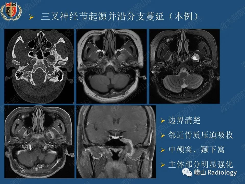 影像PPT - 【病例】三叉神经神经鞘瘤1例CT及MR影像-28