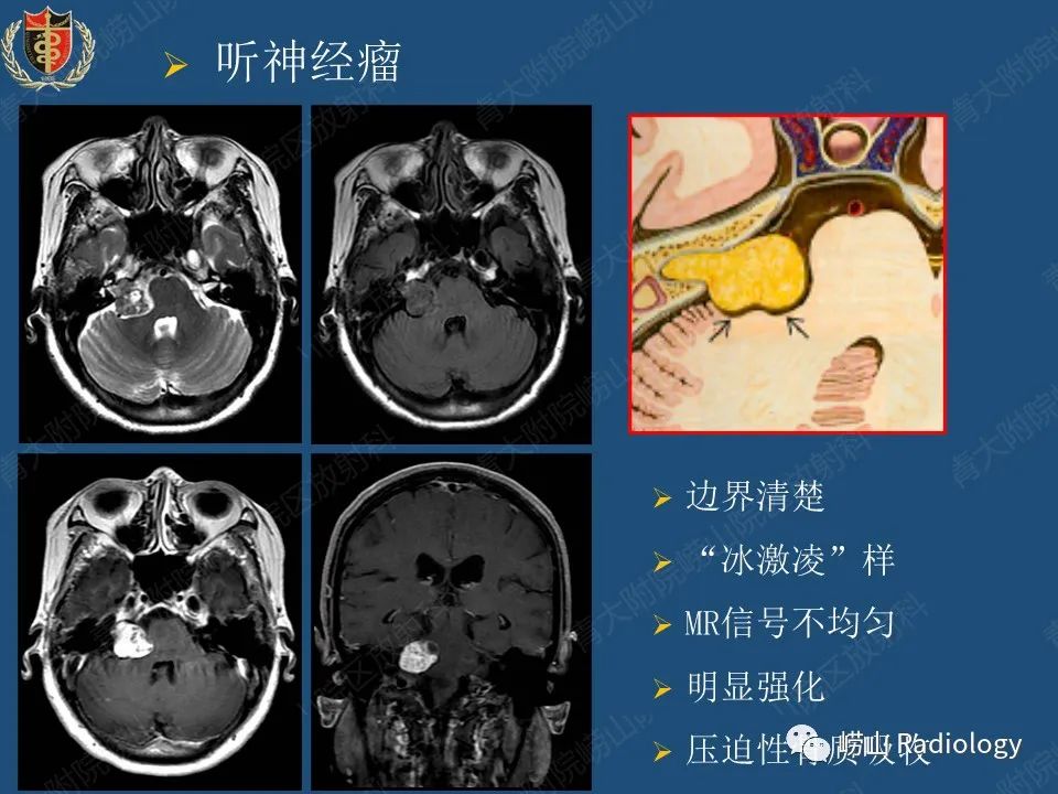 影像PPT - 【病例】三叉神经神经鞘瘤1例CT及MR影像-35