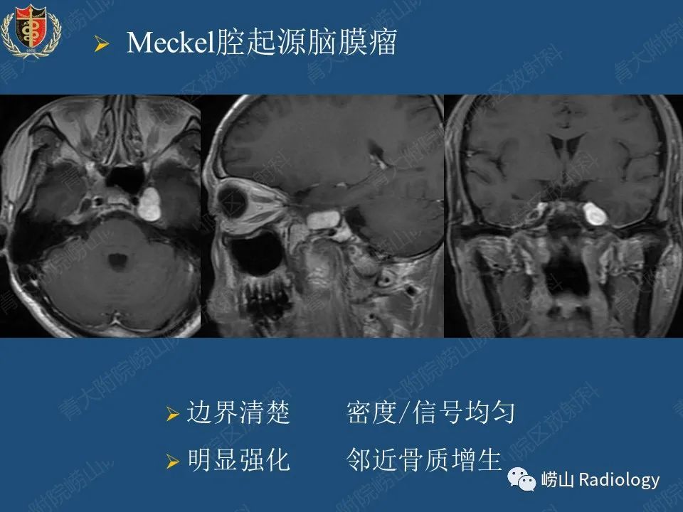 影像PPT - 【病例】三叉神经神经鞘瘤1例CT及MR影像-33