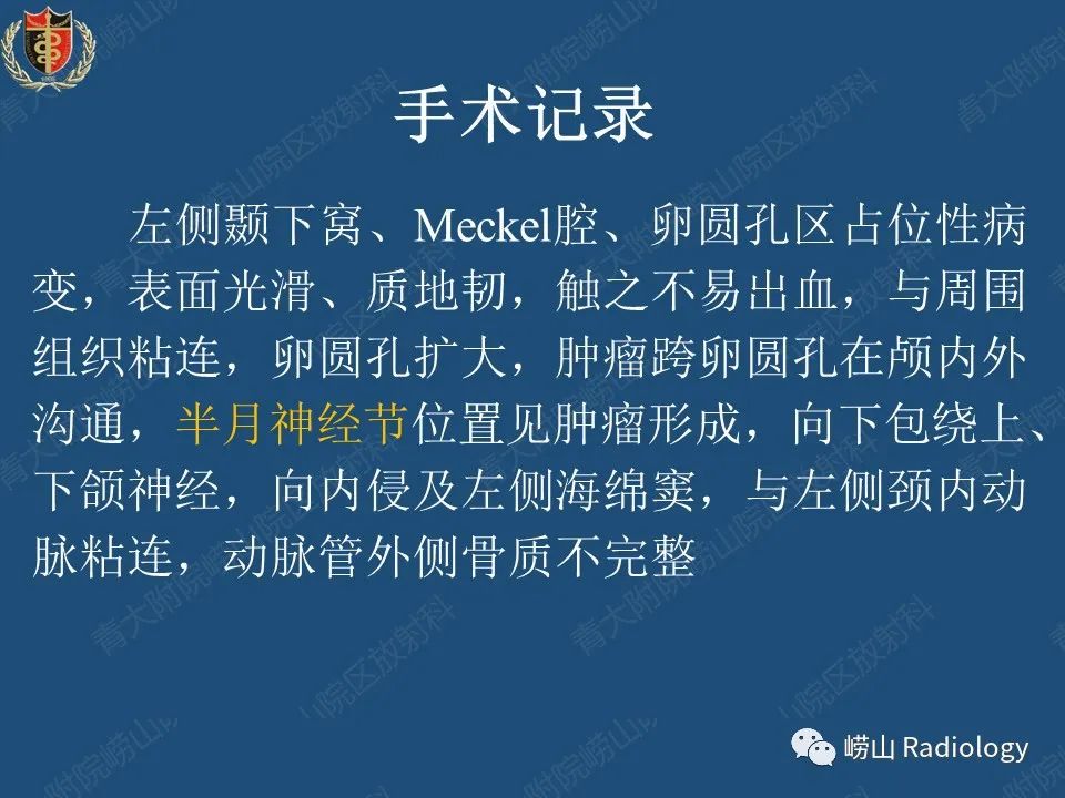 影像PPT - 【病例】三叉神经神经鞘瘤1例CT及MR影像-21