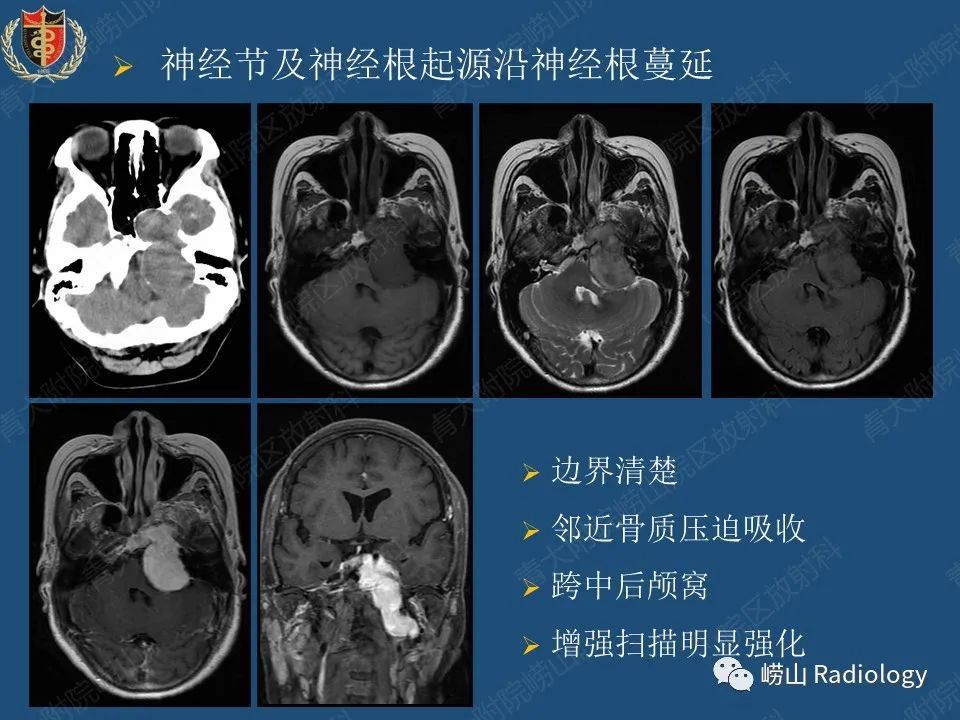 影像PPT - 【病例】三叉神经神经鞘瘤1例CT及MR影像-29