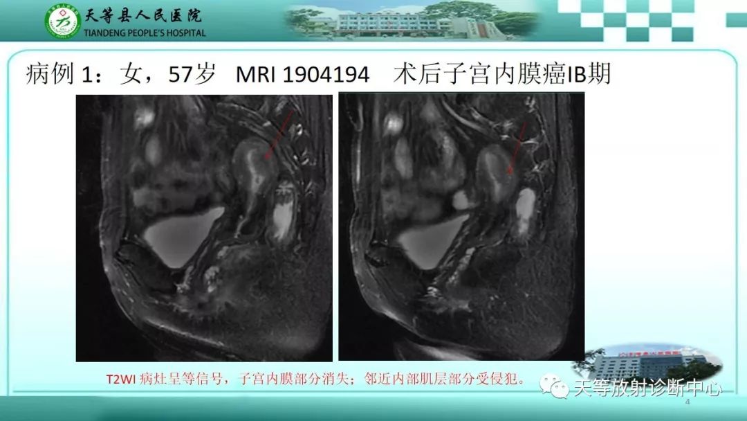 影像PPT - 【PPT】子宫内膜癌MRI诊断要点与鉴别诊断-4
