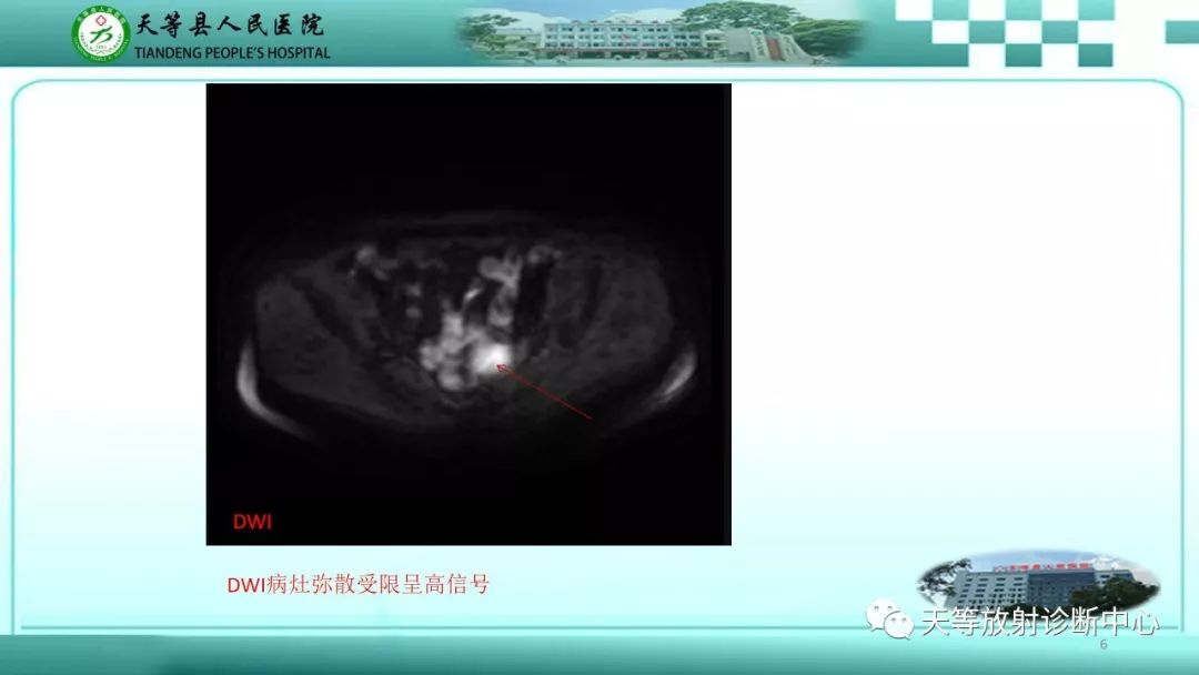 影像PPT - 【PPT】子宫内膜癌MRI诊断要点与鉴别诊断-6