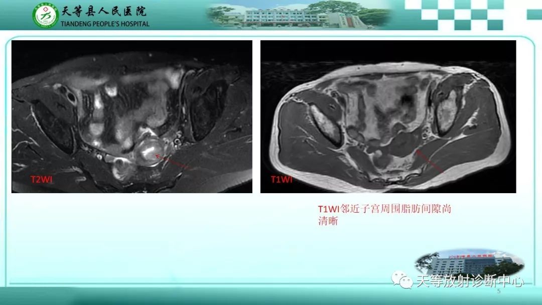 影像PPT - 【PPT】子宫内膜癌MRI诊断要点与鉴别诊断-5