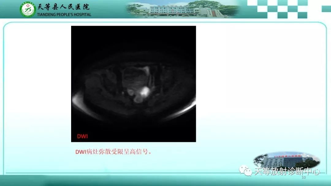 影像PPT - 【PPT】子宫内膜癌MRI诊断要点与鉴别诊断-10
