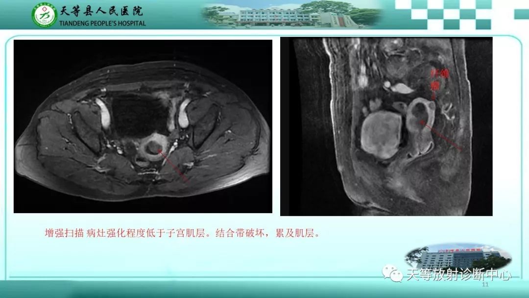 影像PPT - 【PPT】子宫内膜癌MRI诊断要点与鉴别诊断-11