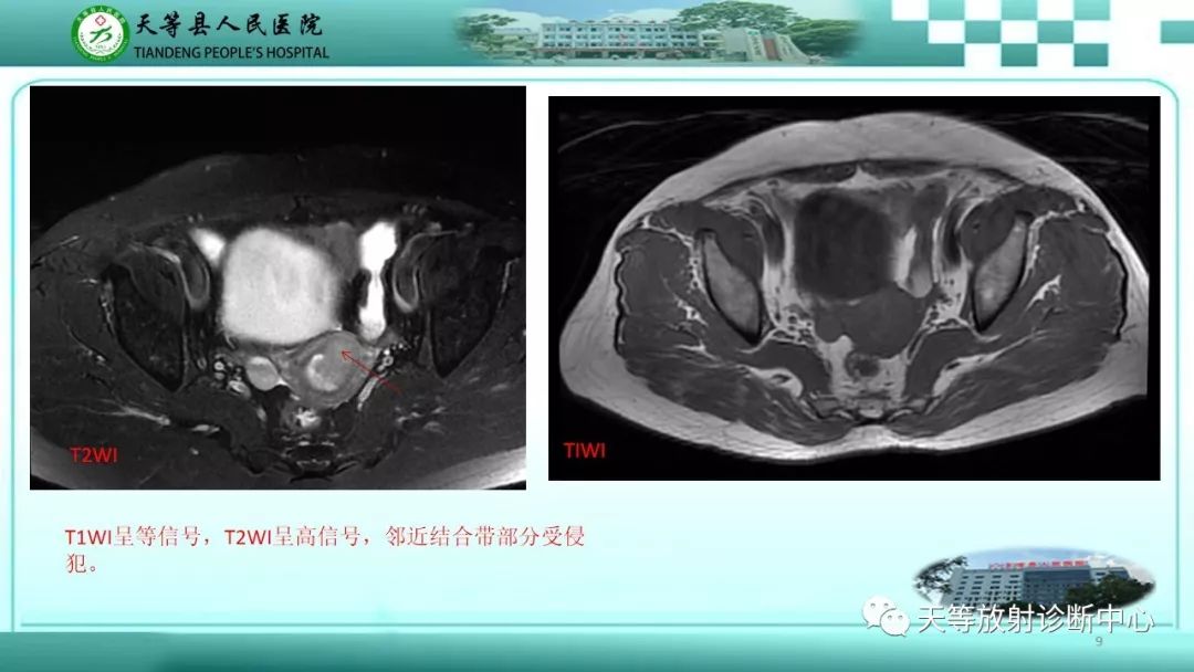 影像PPT - 【PPT】子宫内膜癌MRI诊断要点与鉴别诊断-9