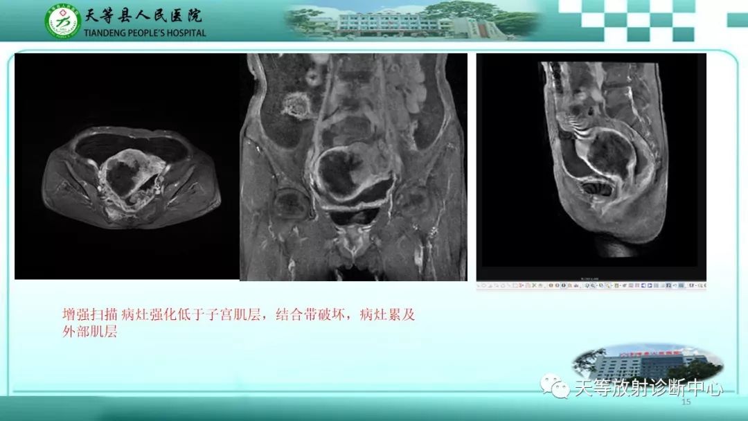 影像PPT - 【PPT】子宫内膜癌MRI诊断要点与鉴别诊断-15