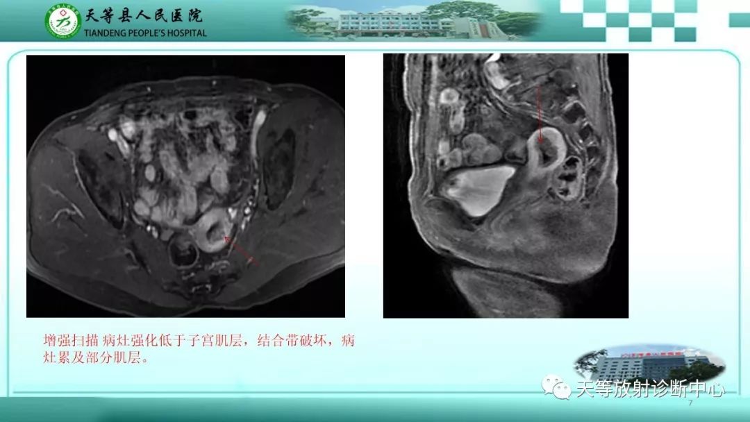 影像PPT - 【PPT】子宫内膜癌MRI诊断要点与鉴别诊断-7