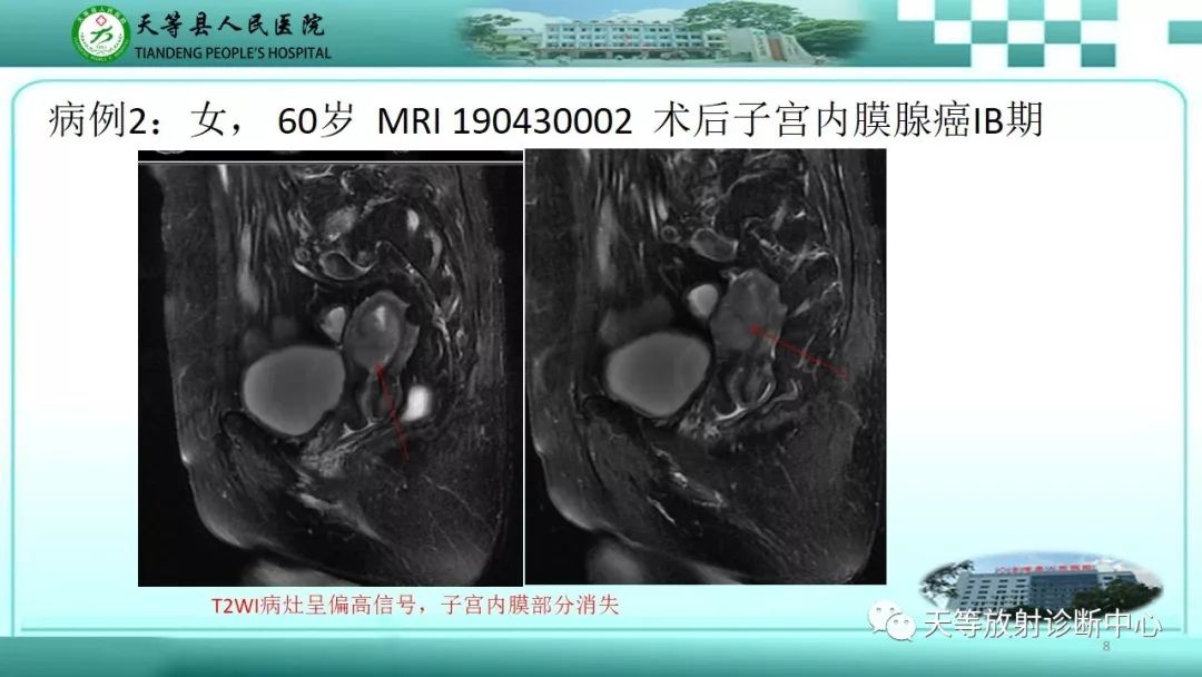 影像PPT - 【PPT】子宫内膜癌MRI诊断要点与鉴别诊断-8