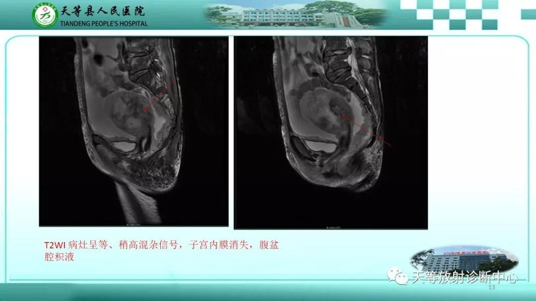 影像PPT - 【PPT】子宫内膜癌MRI诊断要点与鉴别诊断-13