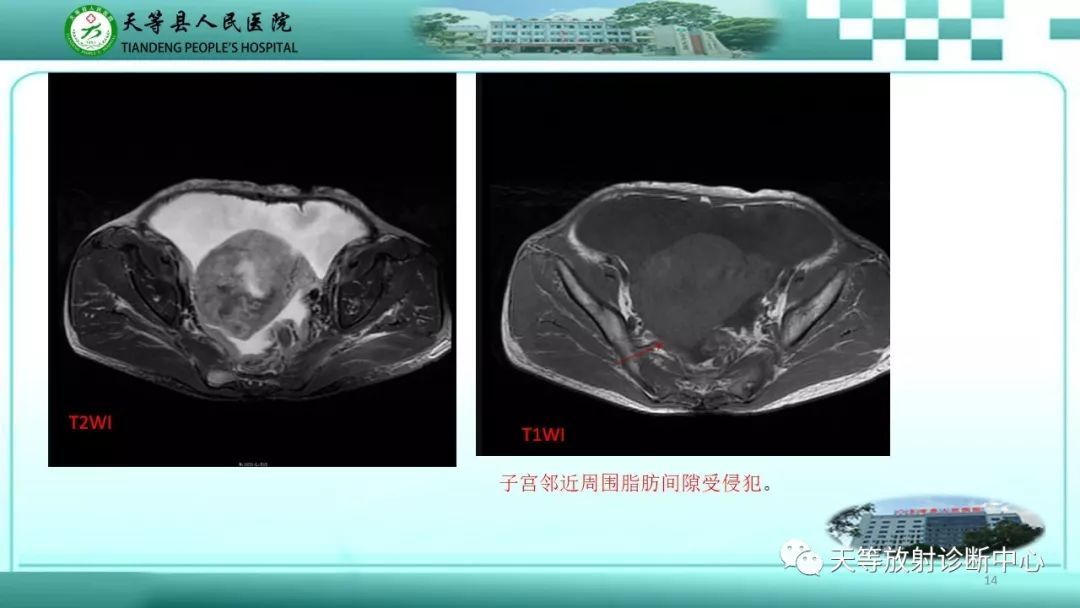 影像PPT - 【PPT】子宫内膜癌MRI诊断要点与鉴别诊断-14